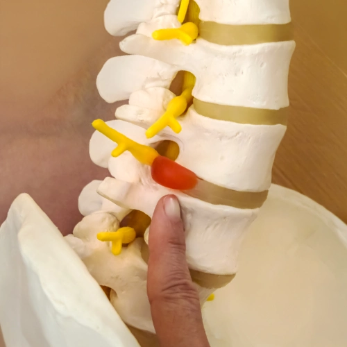 Finger Pointing To Herniated Disc Diagram